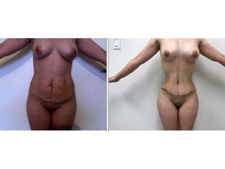 Antes y después de Lipoabdominoplastia