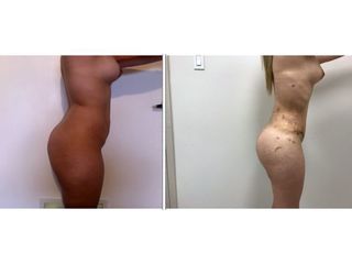 Antes y después de Lipoabdominoplastia