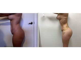 Antes y después de Lipoabdominoplastia