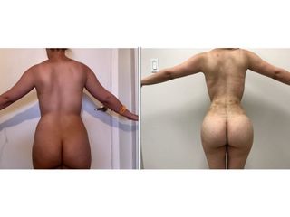 Antes y después de Lipoabdominoplastia