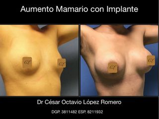 Antes y después de Aumento de busto 