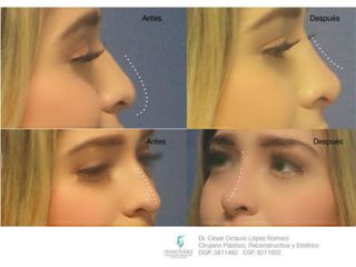 Antes y después de Rinoplastia