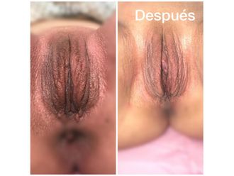 Rejuvenecimiento Vaginal antes y después - 633588