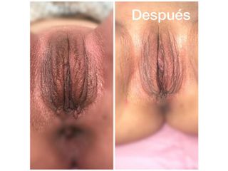 Antes y después de Rejuvenecimiento Vaginal