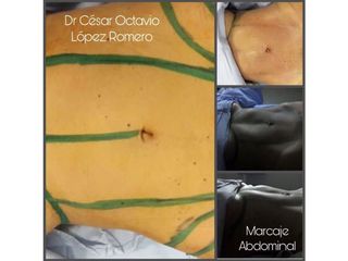 Antes y después de Lipoescultura