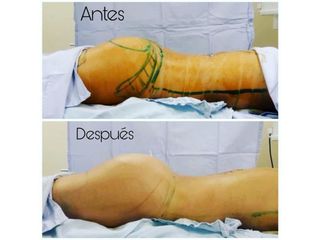 Antes y después de Gluteoplastia