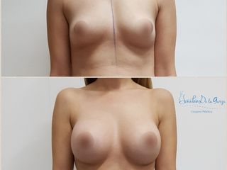 Antes y después de Aumento de busto