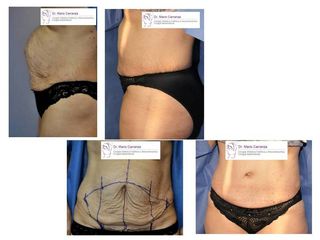 Antes y después de Lipectomía y abdominoplastia
