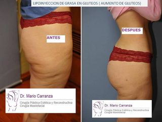 Antes y después de Aumento de glúteos con grasa propia