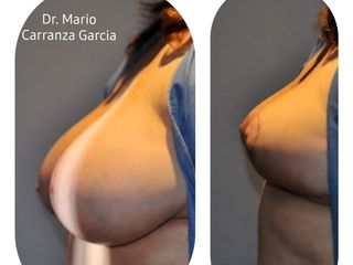 Antes y después de Reducción de mama