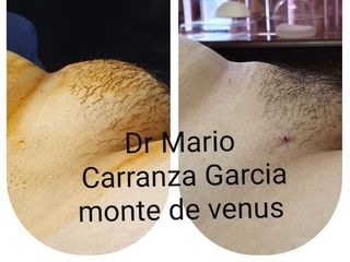 Antes y después de Liposucción Monte Venus