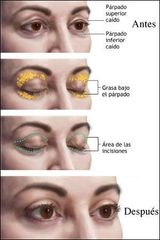 Blefaroplastia