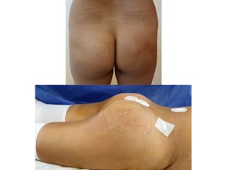Antes y después de Gluteoplastia