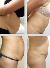 Antes y después de Abdominoplastía
