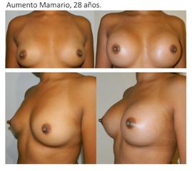 Antes y después de Aumento de busto 