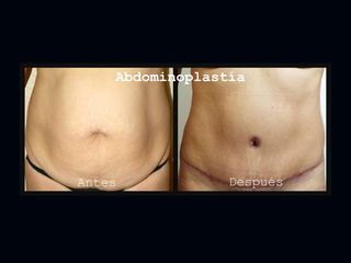 Antes y después de Abdominoplastia