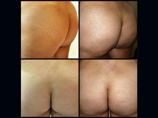Antes y después de Gluteoplastia