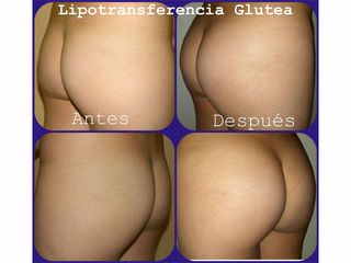Antes y después de Lipotransferencia glútea