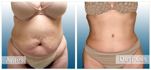 Antes y después de Abdominoplastia
