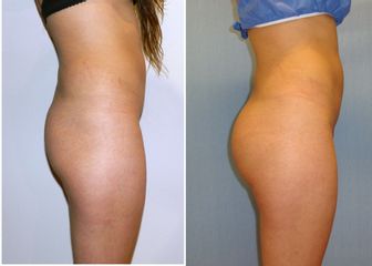 Antes y después de Gluteoplastia