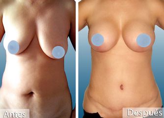 Antes y después de Abdominoplastia+Mamas aumento