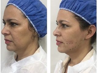 Antes y después de Hilos tensores