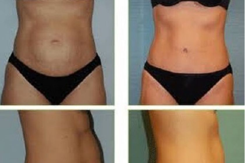 Mesoterapia antes y después - 605375