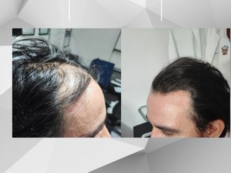 Alopecia - 851014