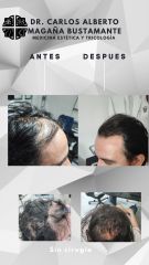 Alopecia - Dr. Carlos Alberto Magaña Bustamante