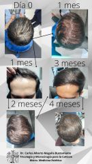 Alopecia - Dr. Carlos Alberto Magaña Bustamante