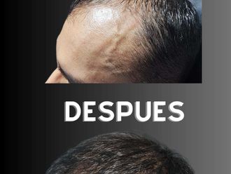Alopecia - 852759