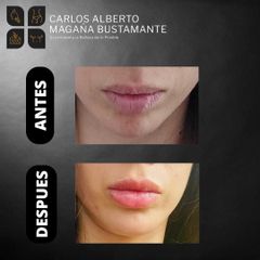 Aumento de labios - Dr. Carlos Alberto Magaña Bustamante