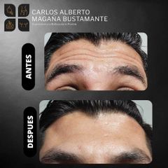 Botox - Dr. Carlos Alberto Magaña Bustamante