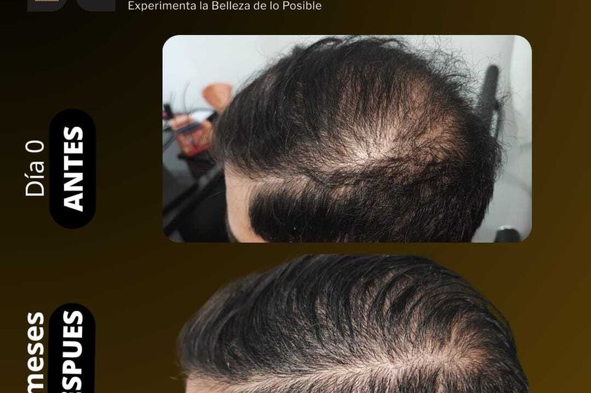 Mesoterapia antes y después - 856507