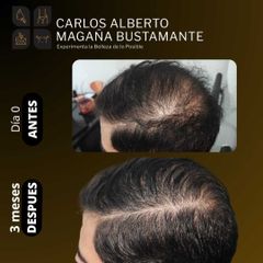 Mesoterapia capilar - Dr. Carlos Alberto Magaña Bustamante