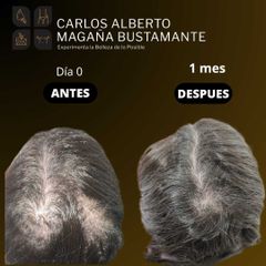 Alopecia Androgénica - Dr. Carlos Alberto Magaña Bustamante