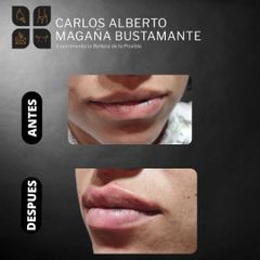Aumento de labios - Dr. Carlos Alberto Magaña Bustamante