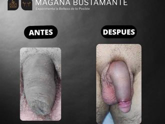 Alargamiento de pene antes y después - 856513