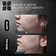 Ácido Hialurónico - Dr. Carlos Alberto Magaña Bustamante