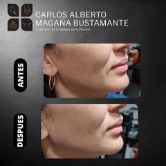 Ácido Hialurónico - Dr. Carlos Alberto Magaña Bustamante