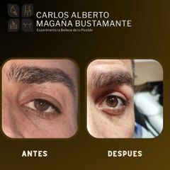 Blefaroplastia - Dr. Carlos Alberto Magaña Bustamante