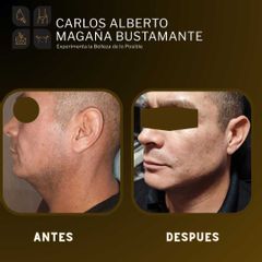 Liposucción de papada - Dr. Carlos Alberto Magaña Bustamante