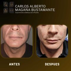 Lipofilling - Dr. Carlos Alberto Magaña Bustamante