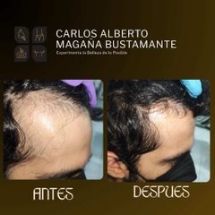 Alopecia Androgenica - Dr. Carlos Alberto Magaña Bustamante