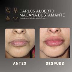 Lips ácido hialurónico - Dr. Carlos Alberto Magaña Bustamante