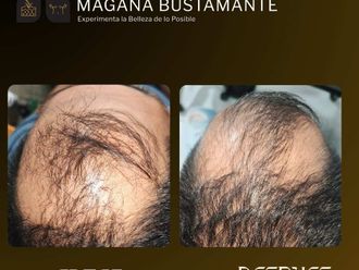 Trasplante de cabello - 863348