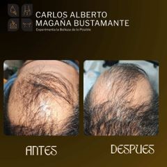 Alopecia cicatrizal y Androgenica - Dr. Carlos Alberto Magaña Bustamante