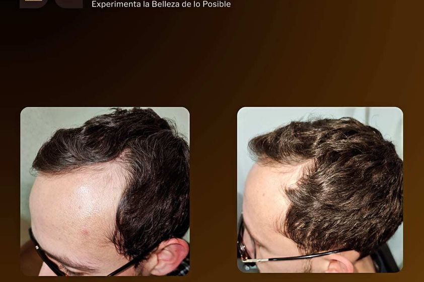 Trasplante de cabello antes y después - 863349