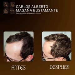 Alopecia Androgenica - Dr. Carlos Alberto Magaña Bustamante