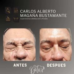 Toxina Botulínica - Dr. Carlos Alberto Magaña Bustamante